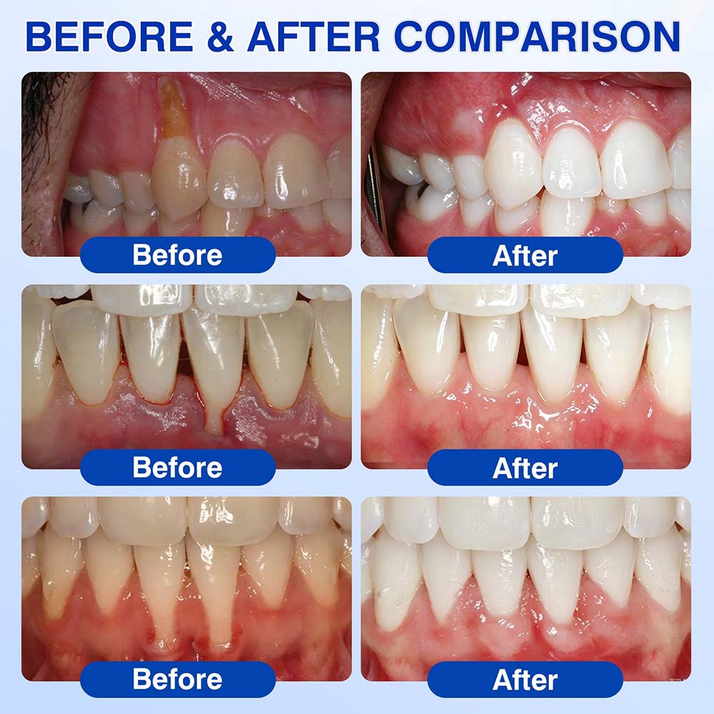 GumRevive Periodontal Repair Gel (for bleeding gums, receding gums, and loose teeth)