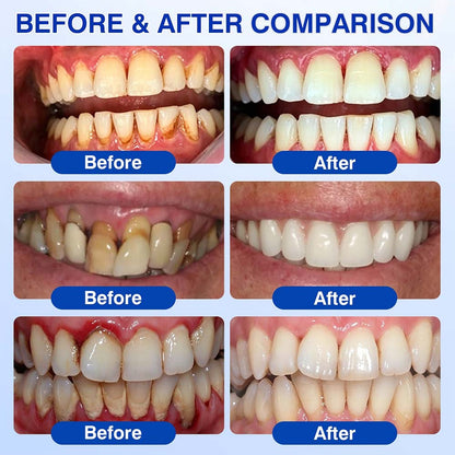 GumRevive Periodontal Repair Gel (for bleeding gums, receding gums, and loose teeth)